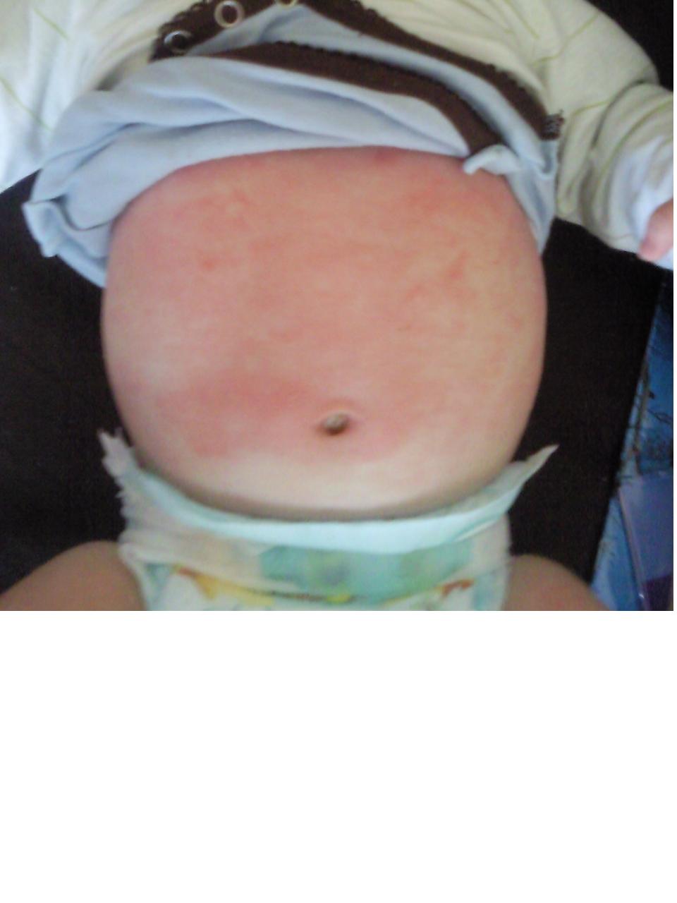 Allergie Aux Plv Comment Savoir Sante De L Enfant Forum Sante Doctissimo Allergie Aux Plv Comment Savoir Sante De L Enfant Forum Sante Doctissimo