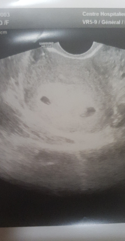 Tubercules De Montgomery Tests Et Symptomes De Grossesse Forum Grossesse Amp Bebe Doctissimo