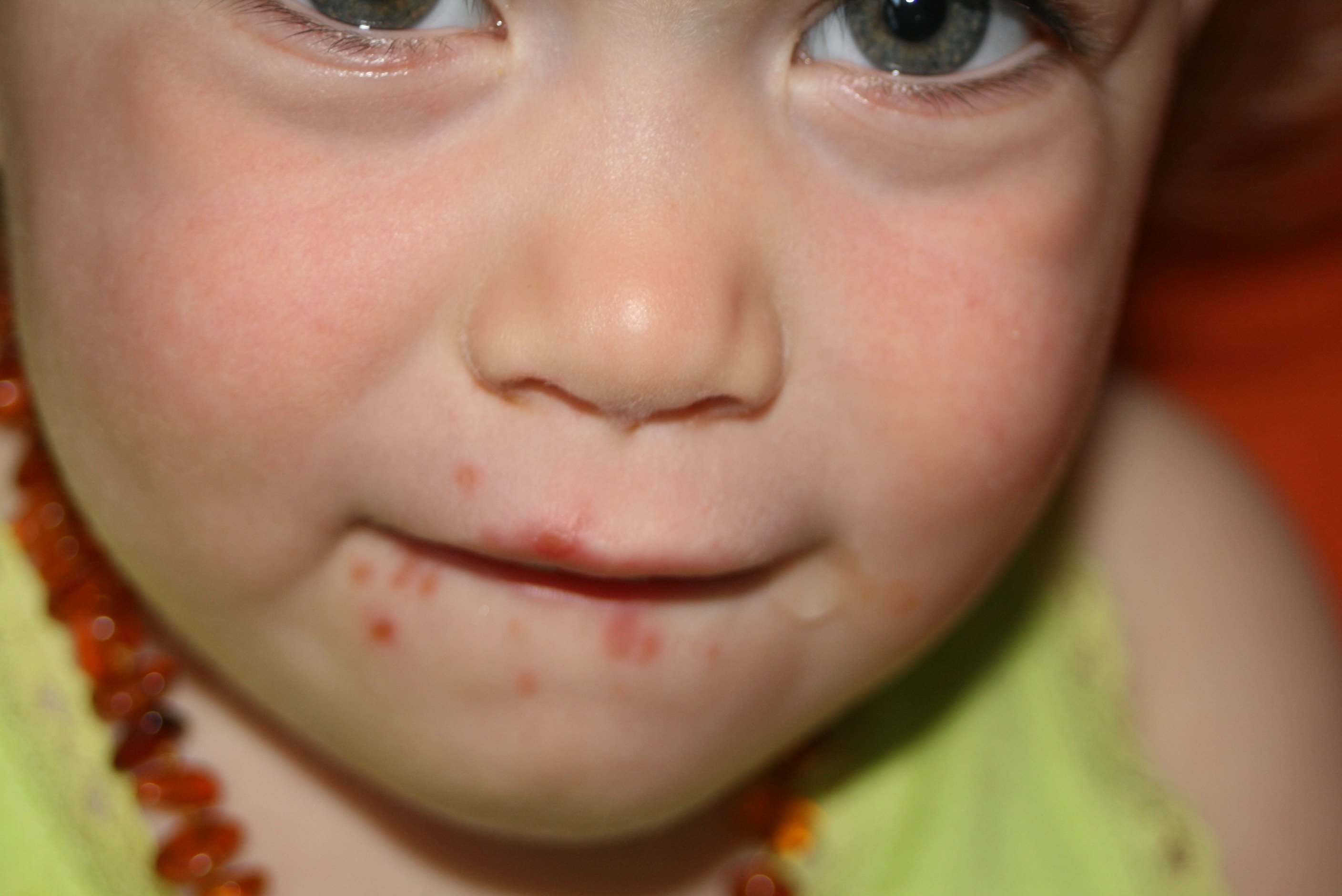 Boutons Autour De La Bouche Bebe Grandit Forum Grossesse Amp Bebe Doctissimo Boutons Autour De La Bouche Bebe Grandit Forum Grossesse Amp Bebe Doctissimo