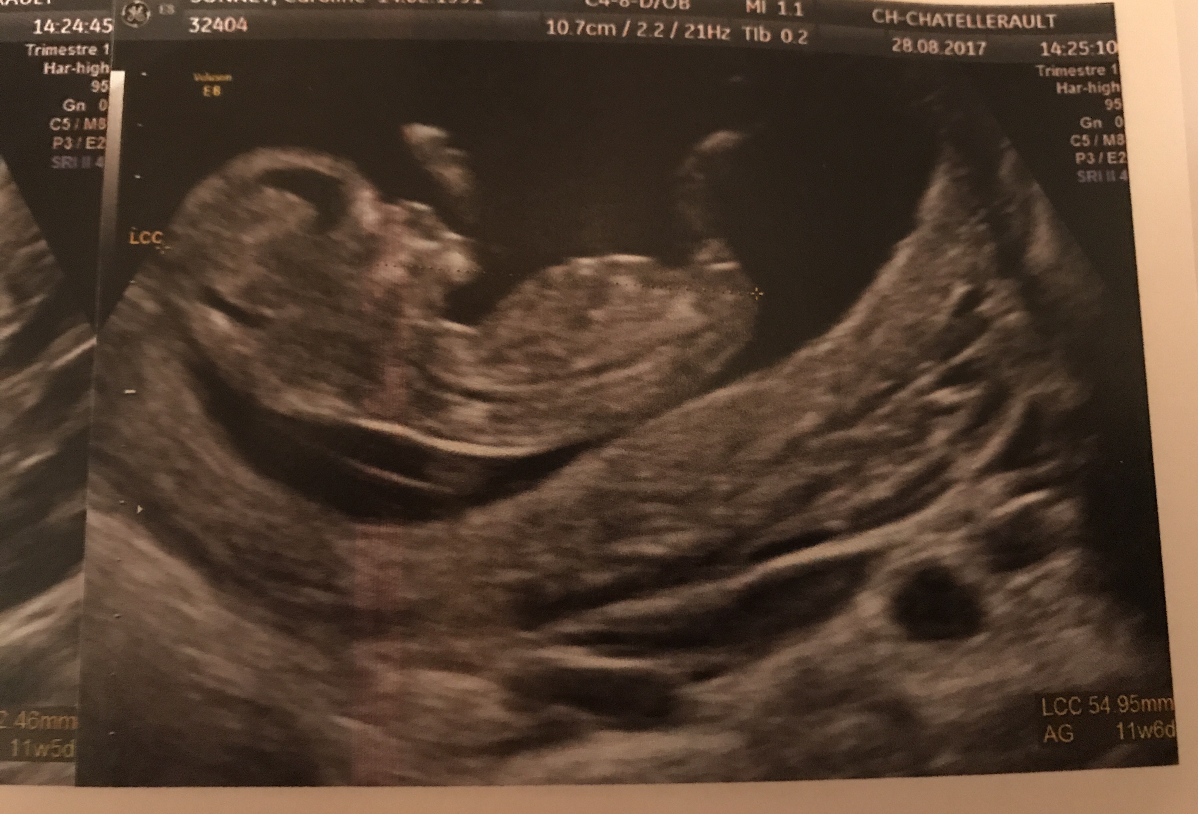 Prediction 100 Ga Et Verdict Fille Echographie Connaitre Le Sexe De Votre Bebe Forum Grossesse Amp Bebe Doctissimo Prediction 100 Ga Et Verdict Fille Echographie Connaitre Le Sexe De Votre Bebe Forum Grossesse Amp Bebe Doctissimo