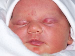 Angiome Sante De L Enfant Forum Sante Doctissimo Angiome Sante De L Enfant Forum Sante Doctissimo