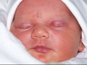Angiome Sante De L Enfant Forum Sante Doctissimo Angiome Sante De L Enfant Forum Sante Doctissimo