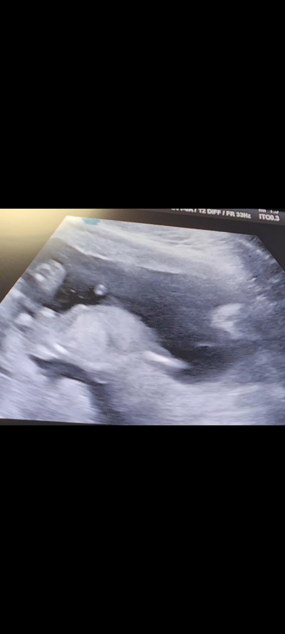 Deni De Grossesse Se Voit Sur Un Test Echo 12 SA fille ou garçon ? - Echographie - FORUM Grossesse & bébé