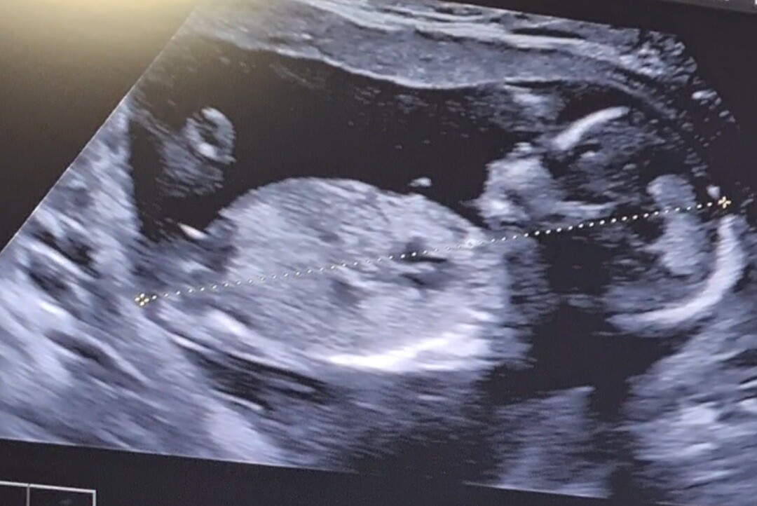 Echo 15 Sa 3 A Votre Avis Fille Ou Garcon Echographie Connaitre Le Sexe De Votre Bebe Forum Grossesse Amp Bebe Doctissimo Echo 15 Sa 3 A Votre Avis Fille Ou Garcon Echographie Connaitre Le Sexe De Votre Bebe Forum Grossesse Amp Bebe Doctissimo