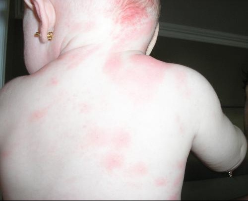 Aide Photos Urticaire Mamans Et Futures Mamans Du Quebec Forum Grossesse Amp Bebe Doctissimo