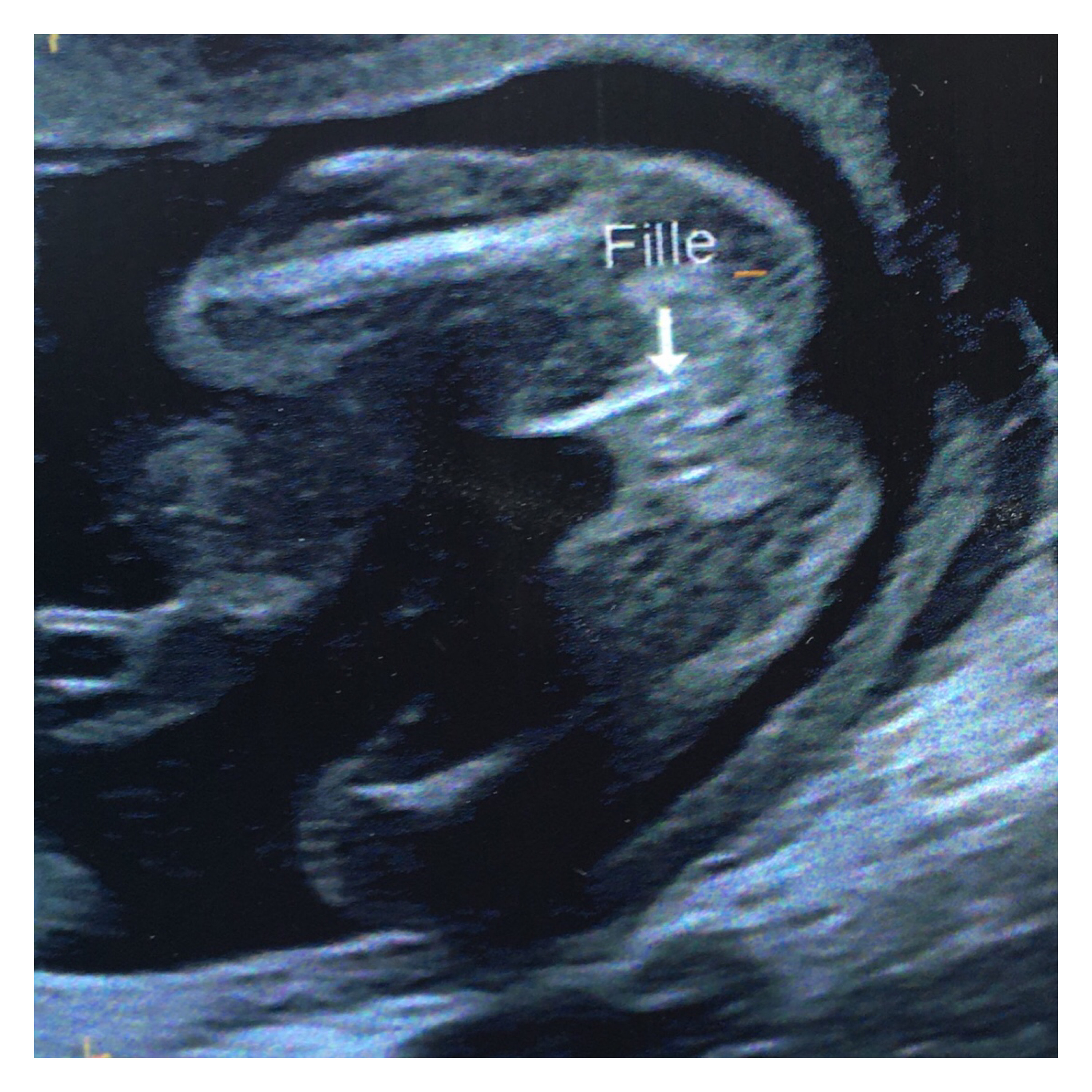 Avis Echo 18sa Fille Ou Garcon Echographie Connaitre Le Sexe De Votre Bebe Forum Grossesse Amp Bebe Doctissimo