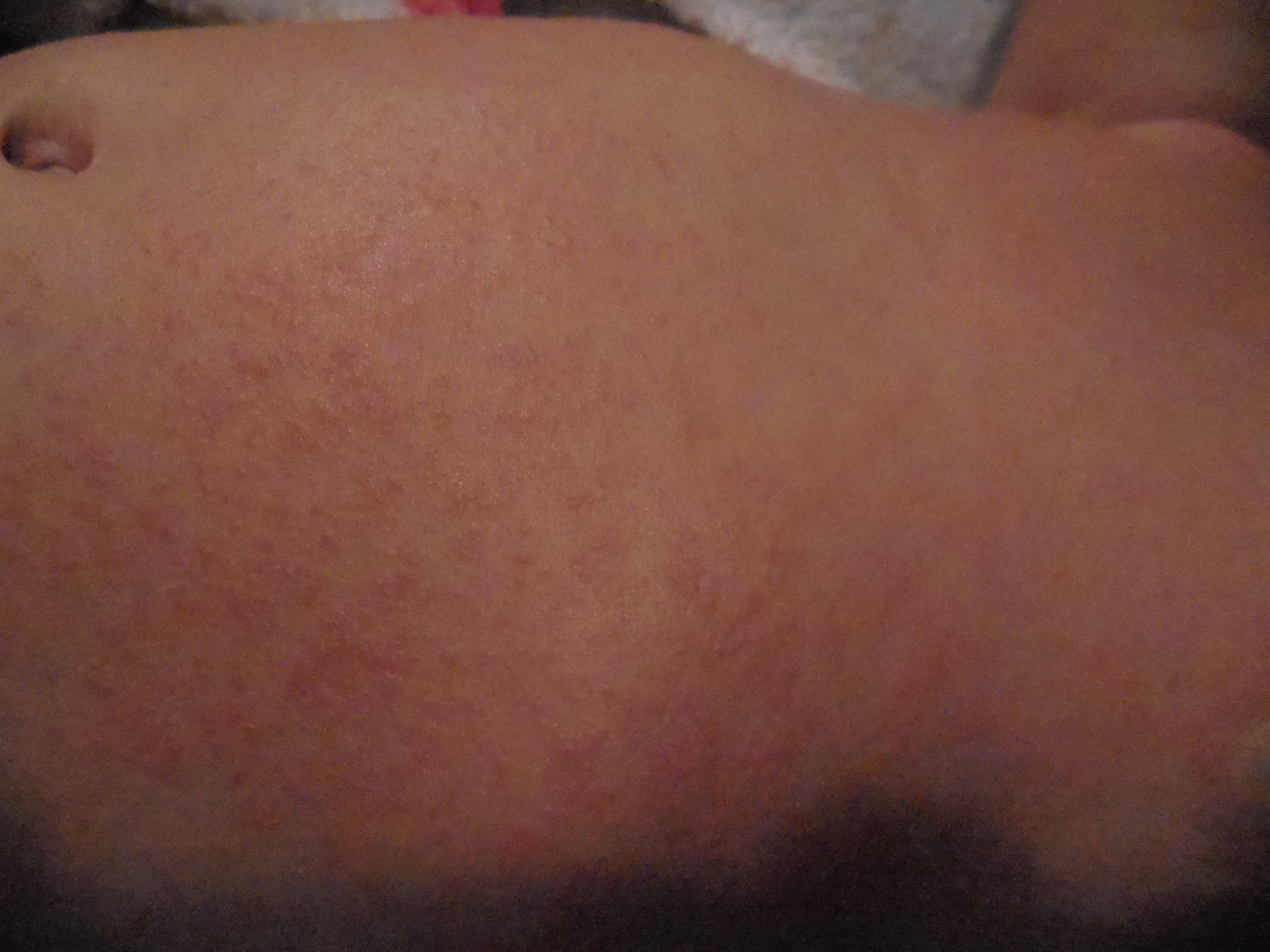 Bouton Sur Tout Le Corps De Bebe Bebe Grandit Forum Grossesse Amp Bebe Doctissimo Bouton Sur Tout Le Corps De Bebe Bebe Grandit Forum Grossesse Amp Bebe Doctissimo