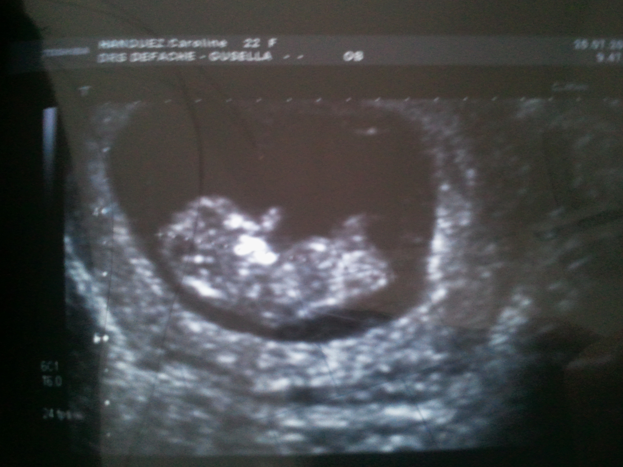 Rose Ou Bleu Echo De 10 Semaines Et 4 Jours Echographie Connaitre Le Sexe De Votre Bebe Forum Grossesse Amp Bebe Doctissimo Rose Ou Bleu Echo De 10 Semaines Et 4 Jours Echographie Connaitre Le Sexe De Votre Bebe Forum Grossesse Amp Bebe Doctissimo
