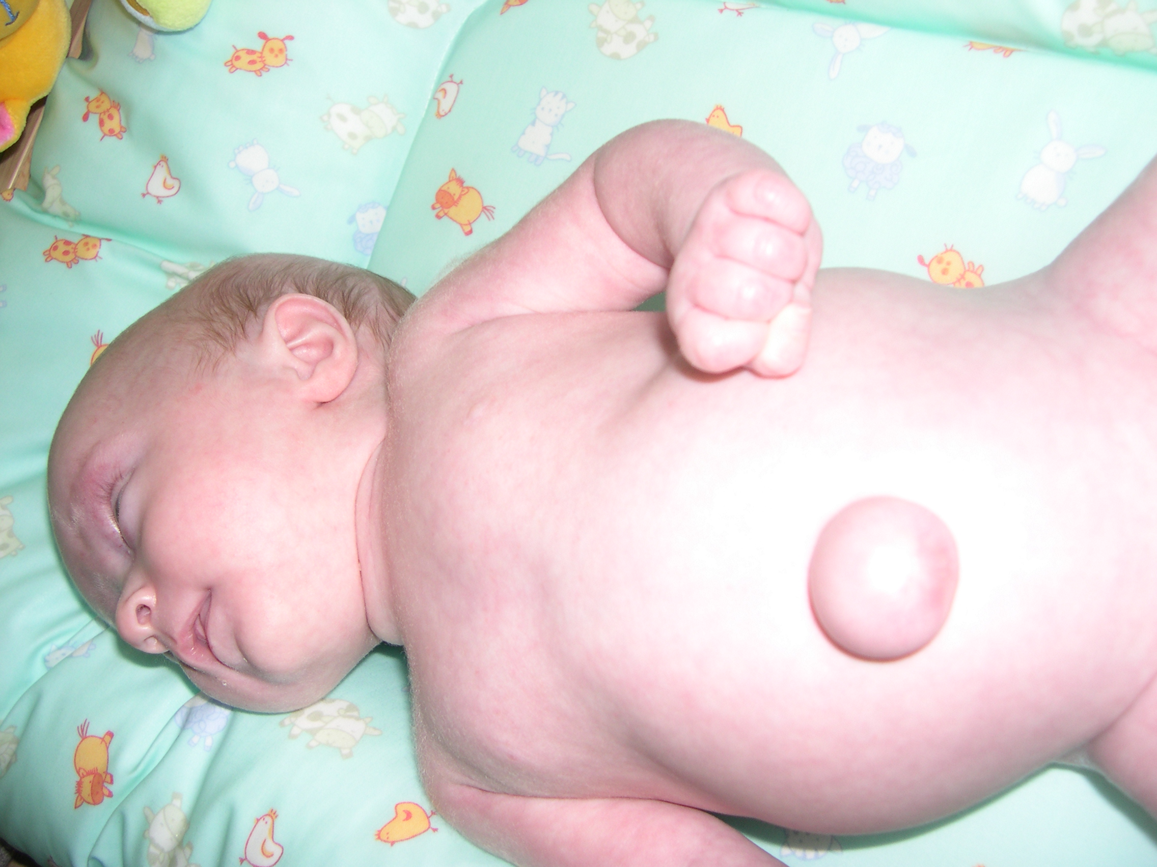 Hernie Ombilicale Due A La Prematurite Prematures Forum Grossesse Amp Bebe Doctissimo Hernie Ombilicale Due A La Prematurite Prematures Forum Grossesse Amp Bebe Doctissimo