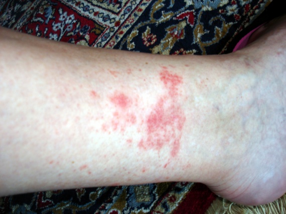 Plaques rouges sur chevilles après marche de plus de 3h - Sport et ...