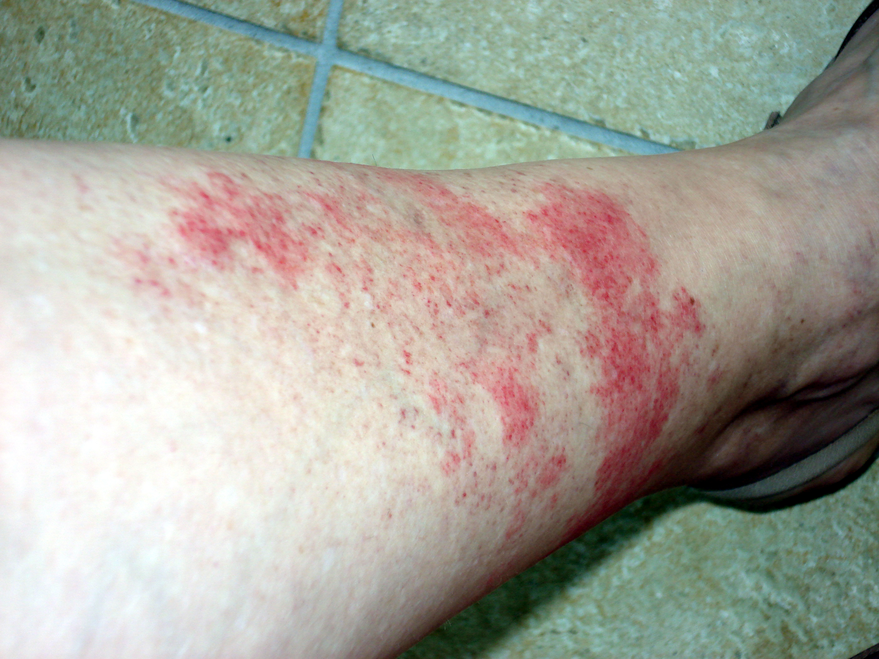 boutons après rasage jambes