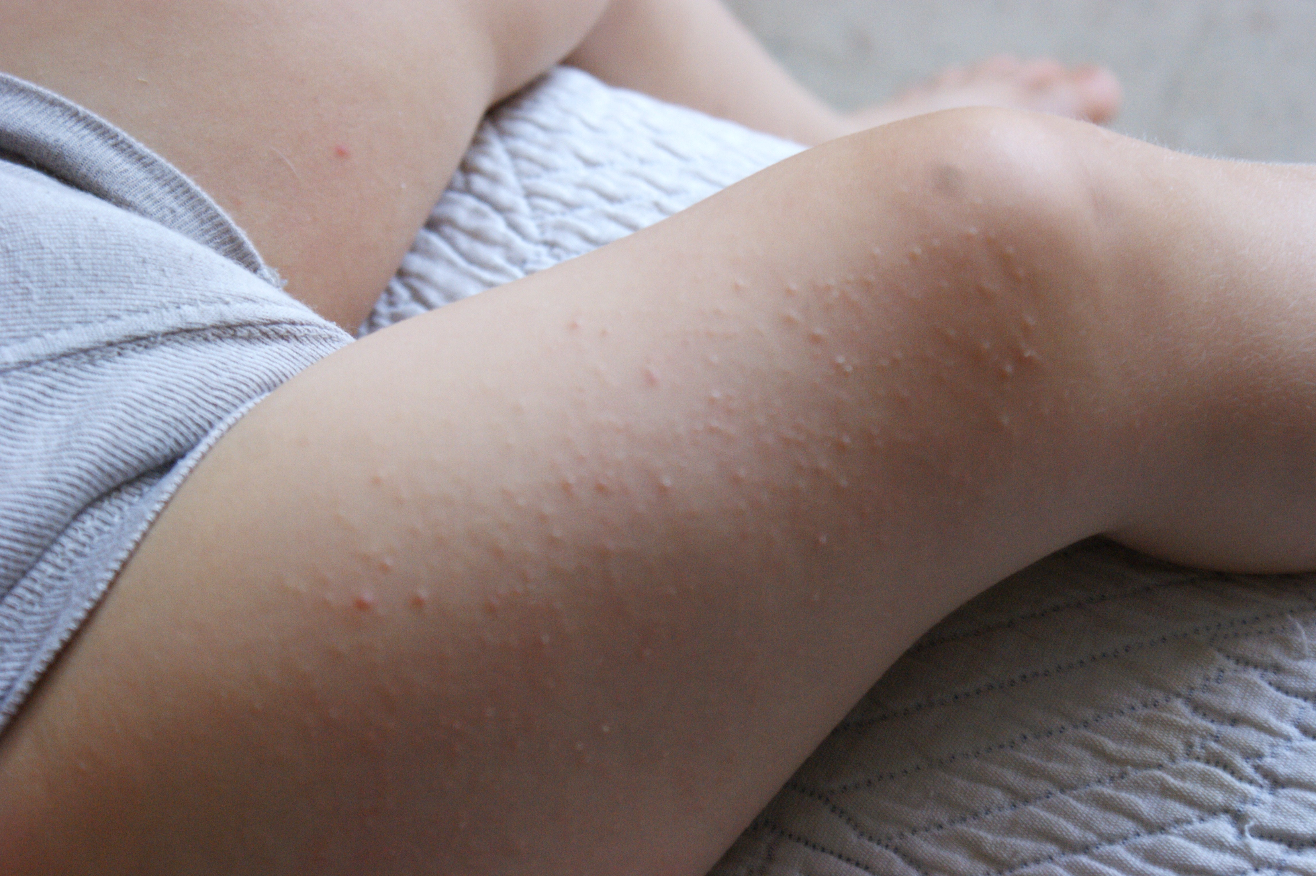 Boutons Enfant 2 Ans Allergies Et Eczema Forum Sante Doctissimo Boutons Enfant 2 Ans Allergies Et Eczema Forum Sante Doctissimo