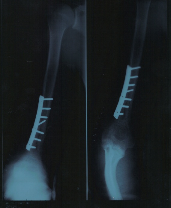 Fracture spiroide humerus "bras de fer" Accidents sportifs FORUM