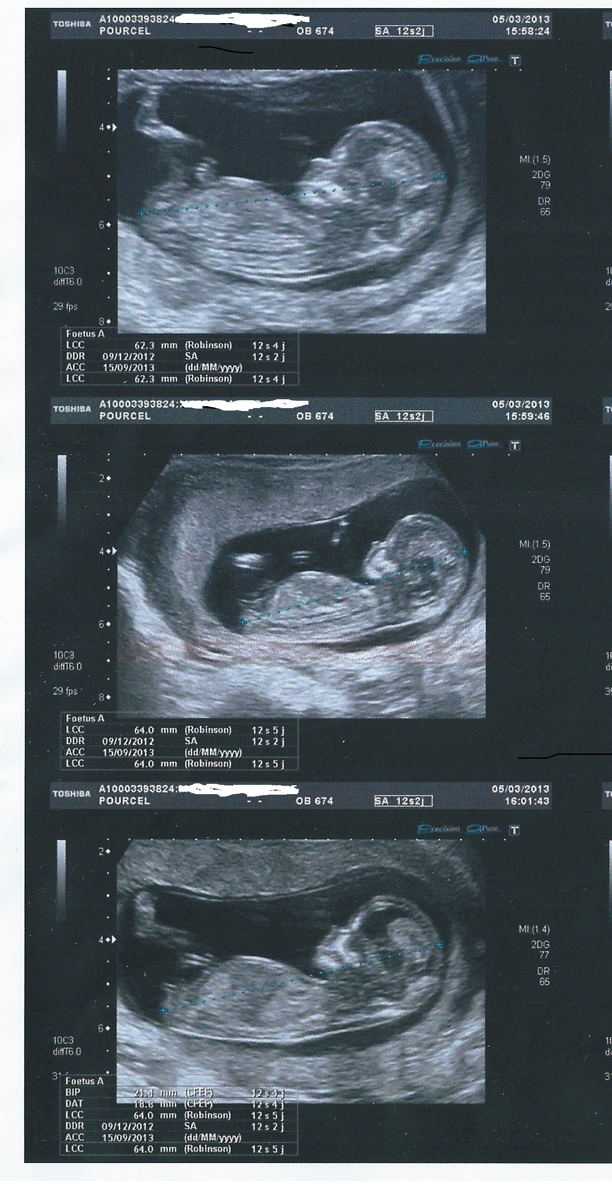 Avis Au Expert Pour Determiner Sexe Bebe Sur Echo 12sa 2 Echographie Connaitre Le Sexe De Votre Bebe Forum Grossesse Amp Bebe Doctissimo Avis Au Expert Pour Determiner Sexe Bebe Sur Echo 12sa 2 Echographie Connaitre Le Sexe De Votre Bebe Forum Grossesse Amp Bebe Doctissimo