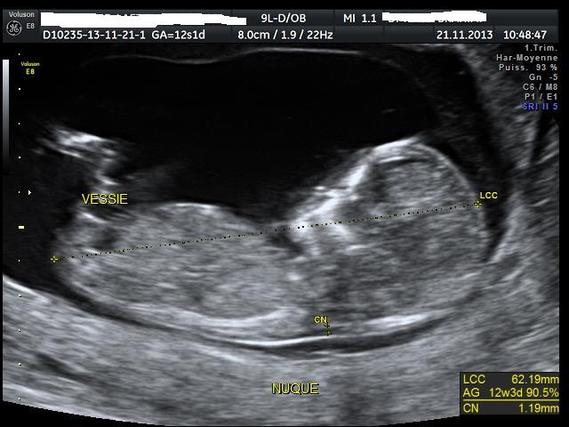 Echo 12SA+2 Fille ou garçon? Vos avis les filles - Echographie - FORUM