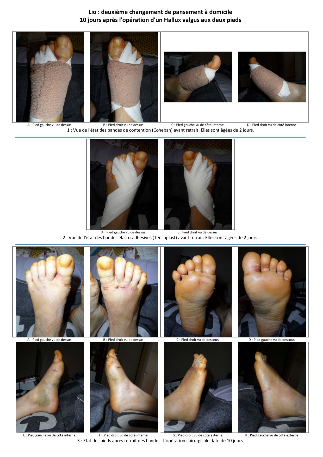 Hallux Valgus Cote Exterieur Lio Hallux Valgus 11 03 2012 Page 1 Hallux Valgus Lio938
