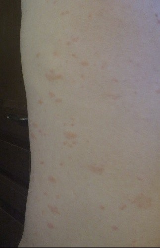 Taches rouge sur la peau ! :( - Acné, psoriasis et ... Taches rouge sur la peau ! :( - Acné, psoriasis et ...