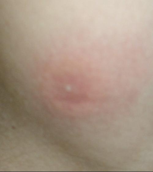 Boutons Rouges Boutons Rouges