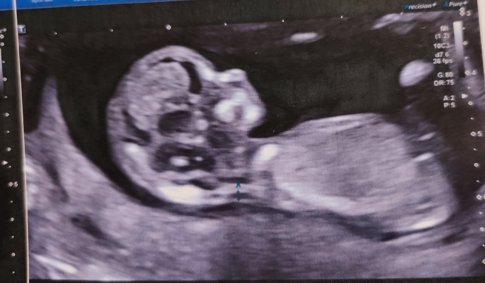 Echo 12 Sa 4 Lcc 61 6 Estimation Fille Ou Garcon Echographie Connaitre Le Sexe De Votre Bebe Forum Grossesse Amp Bebe Doctissimo