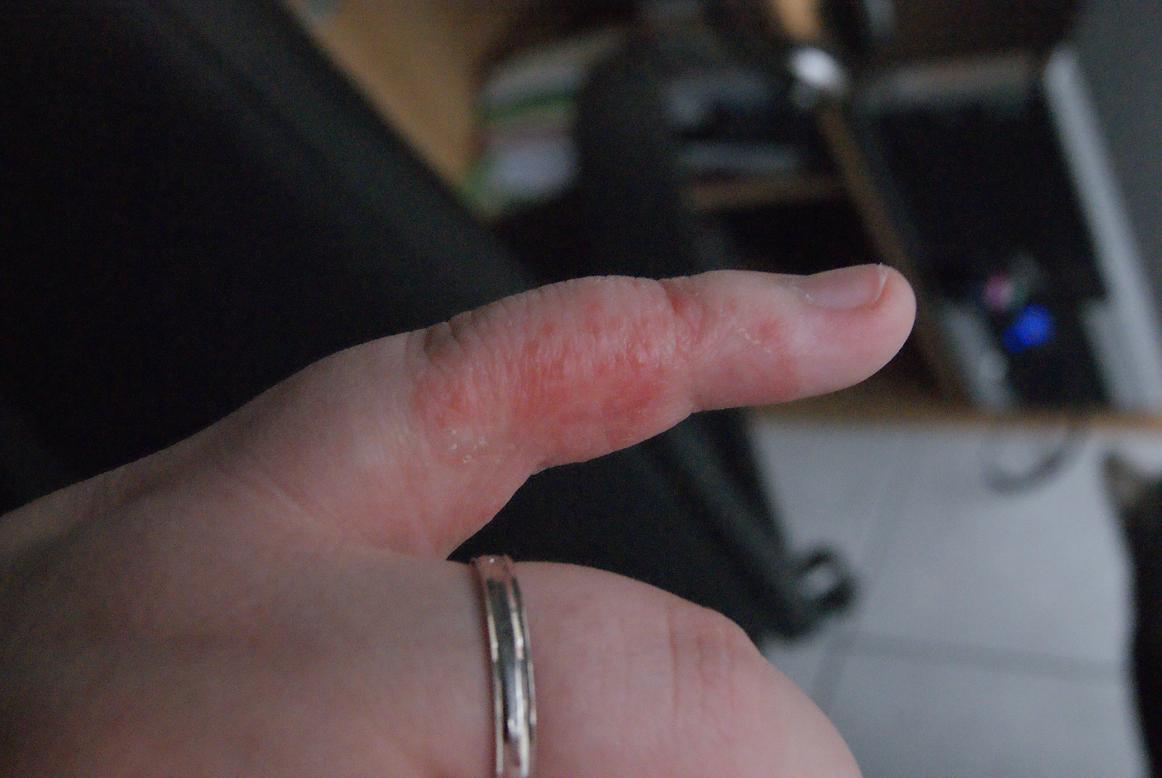 La Peau Qui Pele Acne Psoriasis Et Problemes De Peau Forum Sante Doctissimo La Peau Qui Pele Acne Psoriasis Et Problemes De Peau Forum Sante Doctissimo