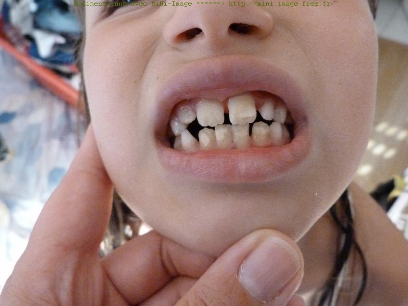 Temoignages De Parents Ayant Des Enfant Savec Une Mih Dentaire Problemes Dentaires Forum Sante Doctissimo Temoignages De Parents Ayant Des Enfant Savec Une Mih Dentaire Problemes Dentaires Forum Sante Doctissimo