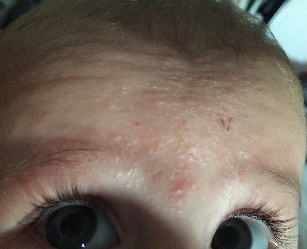 Dormitor Sida Apoi Plein De Petit Bouton Sur Le Visage Mommaloveswellness Com