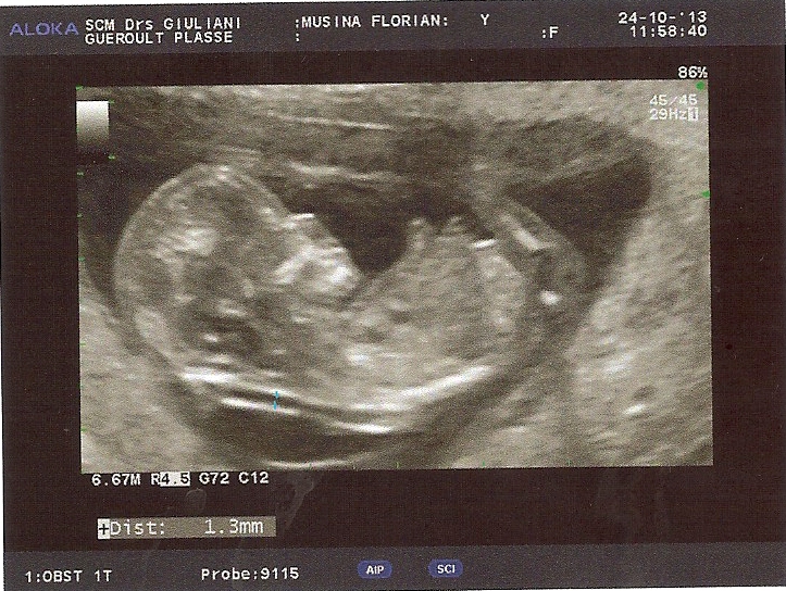 Echo Des 3 Mois Fille Ou Garcon Echographie Connaitre Le Sexe De Votre Bebe Forum Grossesse Amp Bebe Doctissimo Echo Des 3 Mois Fille Ou Garcon Echographie Connaitre Le Sexe De Votre Bebe Forum Grossesse Amp Bebe Doctissimo