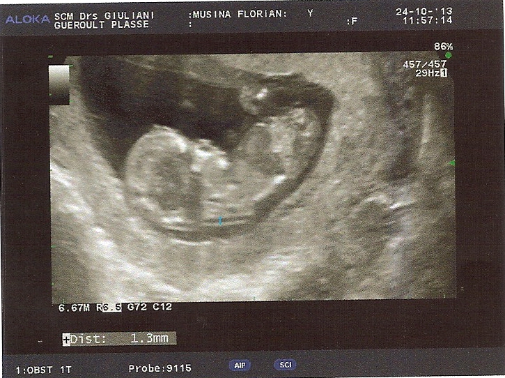 Echo Des 3 Mois Fille Ou Garcon Echographie Connaitre Le Sexe De Votre Bebe Forum Grossesse Amp Bebe Doctissimo Echo Des 3 Mois Fille Ou Garcon Echographie Connaitre Le Sexe De Votre Bebe Forum Grossesse Amp Bebe Doctissimo