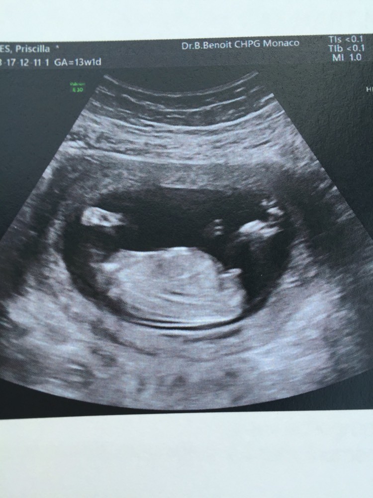 Ou Est Le Bourgeon 13 Sa 6 Echographie Connaitre Le Sexe De Votre Bebe Forum Grossesse Amp Bebe Doctissimo Ou Est Le Bourgeon 13 Sa 6 Echographie Connaitre Le Sexe De Votre Bebe Forum Grossesse Amp Bebe Doctissimo