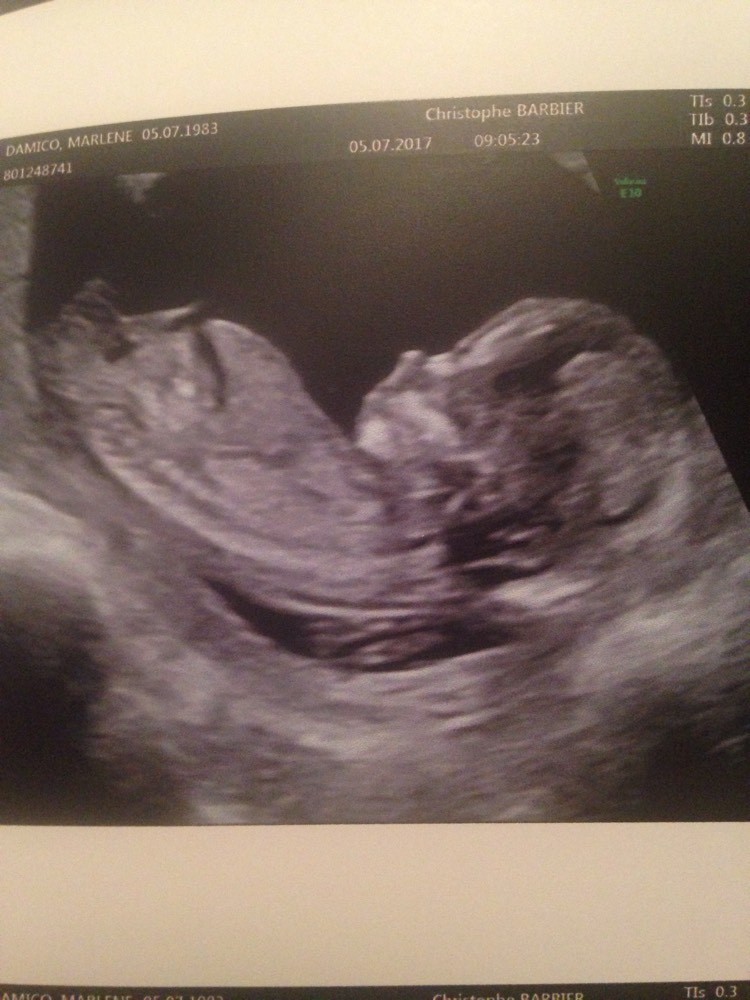 Echo Sexe Echographie Connaitre Le Sexe De Votre Bebe Forum Grossesse Amp Bebe Doctissimo