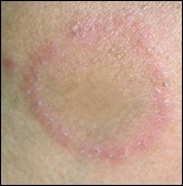 Une tache rose sur mon ventre - Forum libre Santé - FORUM Santé - Club ...