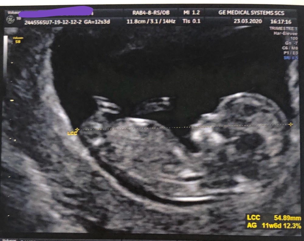 Echographie T1 Soucis Echographie Connaitre Le Sexe De Votre Bebe Forum Grossesse Amp Bebe Doctissimo Echographie T1 Soucis Echographie Connaitre Le Sexe De Votre Bebe Forum Grossesse Amp Bebe Doctissimo