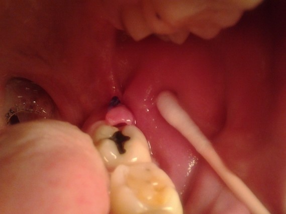 Boule Chair Post Op Extraction Dents De Sagesse