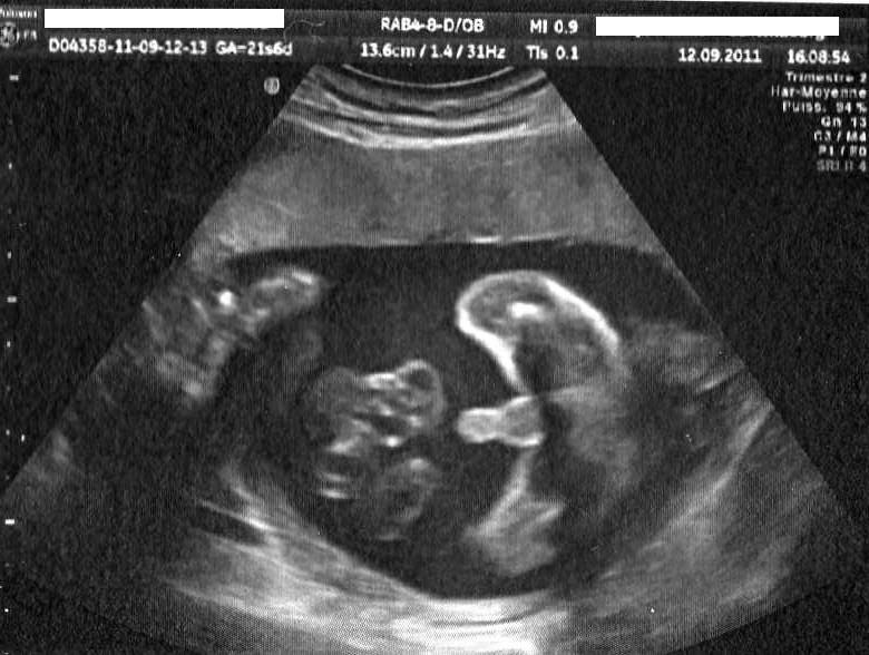 Echo 5 Mois Echographie Connaitre Le Sexe De Votre Bebe Forum Grossesse Amp Bebe Doctissimo Echo 5 Mois Echographie Connaitre Le Sexe De Votre Bebe Forum Grossesse Amp Bebe Doctissimo