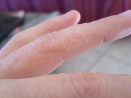 Petit Boutons Rouges Papules Pieds Et Dos Des Mains Allergies Et Eczema Forum Sante Doctissimo Petit Boutons Rouges Papules Pieds Et Dos Des Mains Allergies Et Eczema Forum Sante Doctissimo