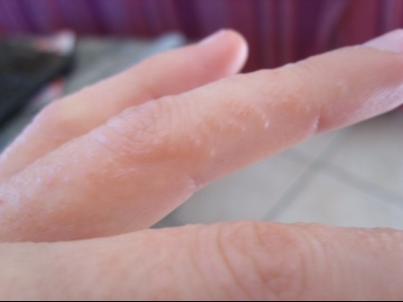 Petit Boutons Rouges Papules Pieds Et Dos Des Mains Allergies Et Eczema Forum Sante Doctissimo Petit Boutons Rouges Papules Pieds Et Dos Des Mains Allergies Et Eczema Forum Sante Doctissimo