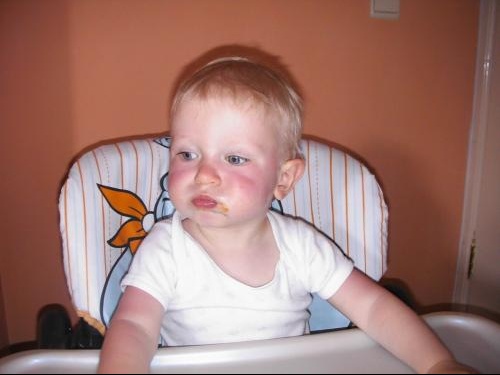 Brulure Retour De L Hopital Brulure Retour De L Hopital