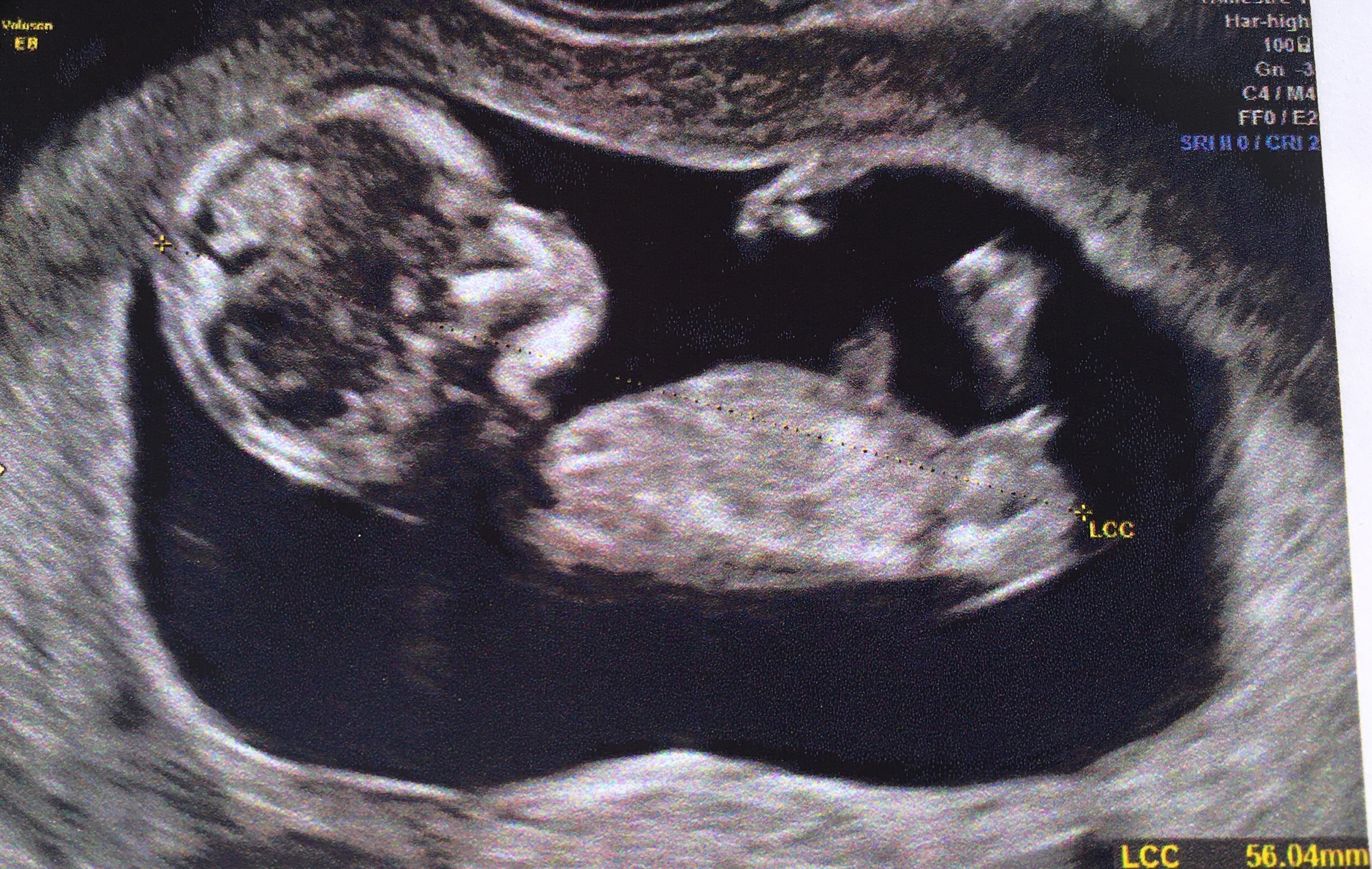 Echographie 12 Sa Sex Du Bebe Echographie Connaitre Le Sexe De Votre Bebe Forum Grossesse Amp Bebe Doctissimo Echographie 12 Sa Sex Du Bebe Echographie Connaitre Le Sexe De Votre Bebe Forum Grossesse Amp Bebe Doctissimo