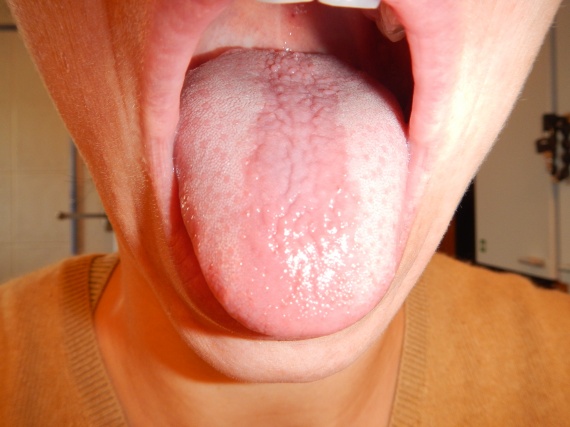 Inflammation Des Papilles Et Taches Sur Le Palais Inflammation Des Papilles Et Taches Sur Le Palais