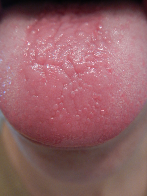 Inflammation Des Papilles Et Taches Sur Le Palais Inflammation Des Papilles Et Taches Sur Le Palais