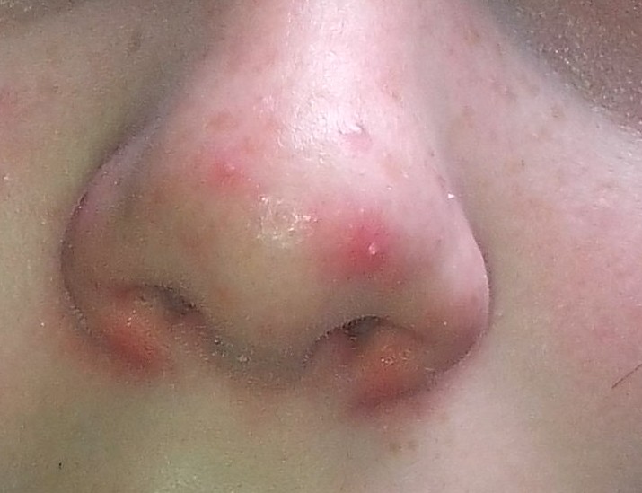 Petit Point Blanc Ou Boutons Sur Le Nez Soin Du Visage Forum Beaute Doctissimo