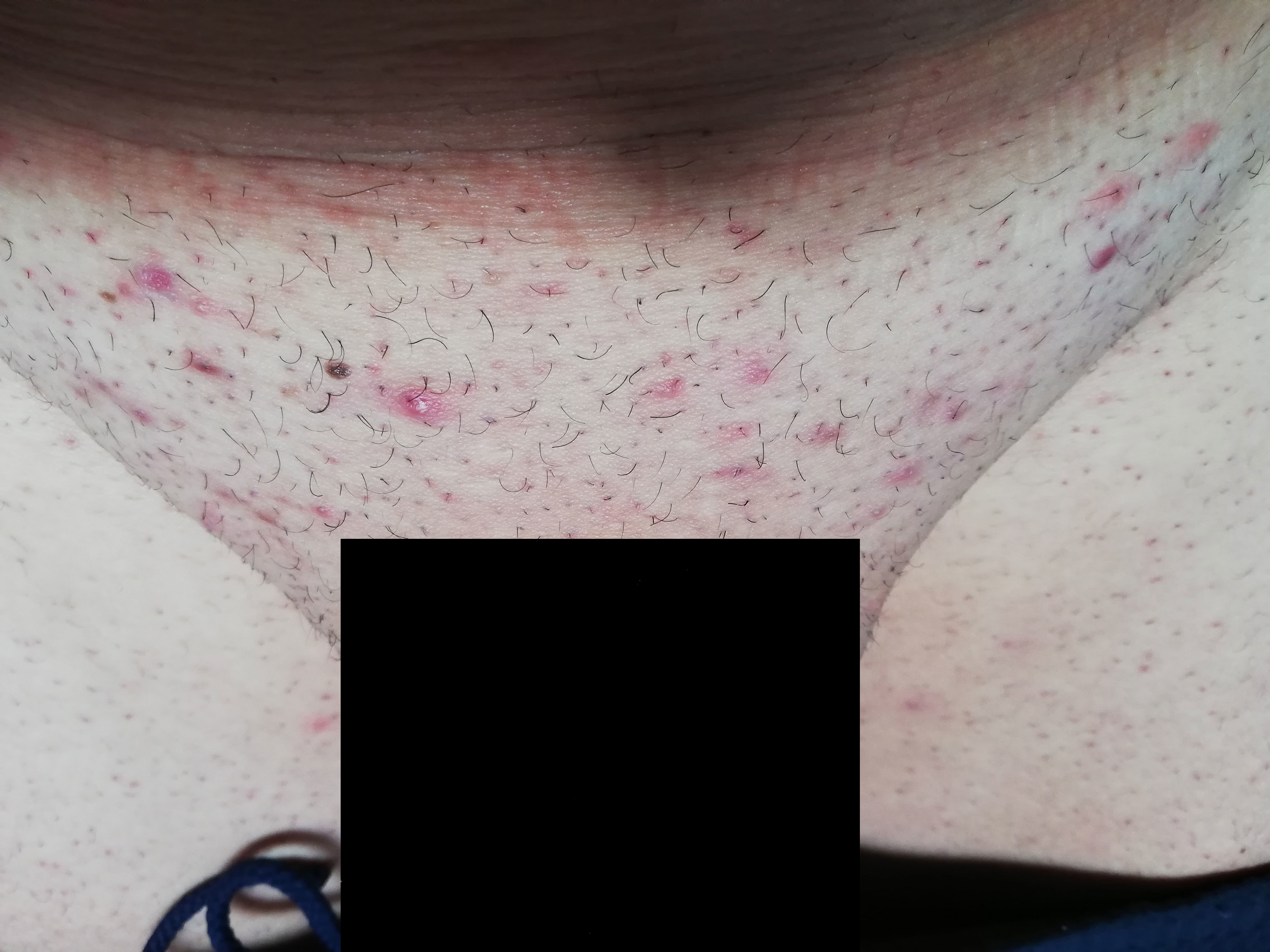 boutons epilation maillot