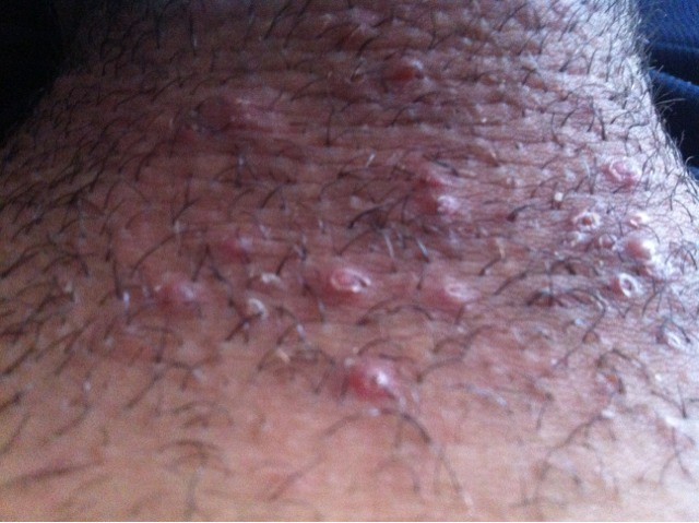 bouton après rasage pubien