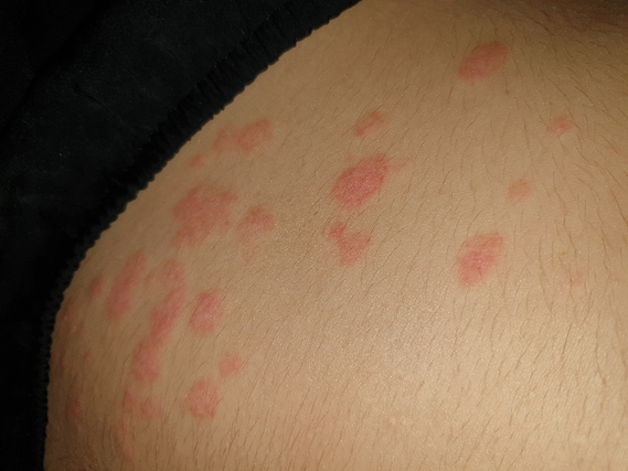 plaques rouge sur le corps help!!!