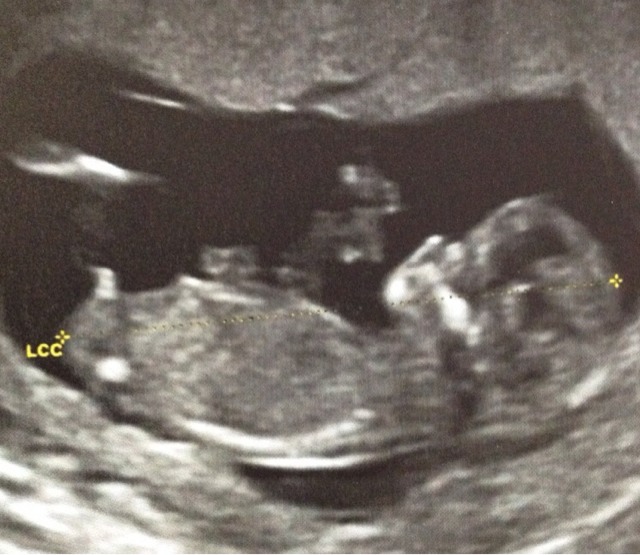 Echo 12sa 5 Bebe Fait Pipi Echographie Connaitre Le Sexe De Votre Bebe Forum Grossesse Amp Bebe Doctissimo Echo 12sa 5 Bebe Fait Pipi Echographie Connaitre Le Sexe De Votre Bebe Forum Grossesse Amp Bebe Doctissimo
