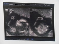 A gauche: vue de profil, A droite: "vue du dessus" bébé à les doigts et les pouces joints...