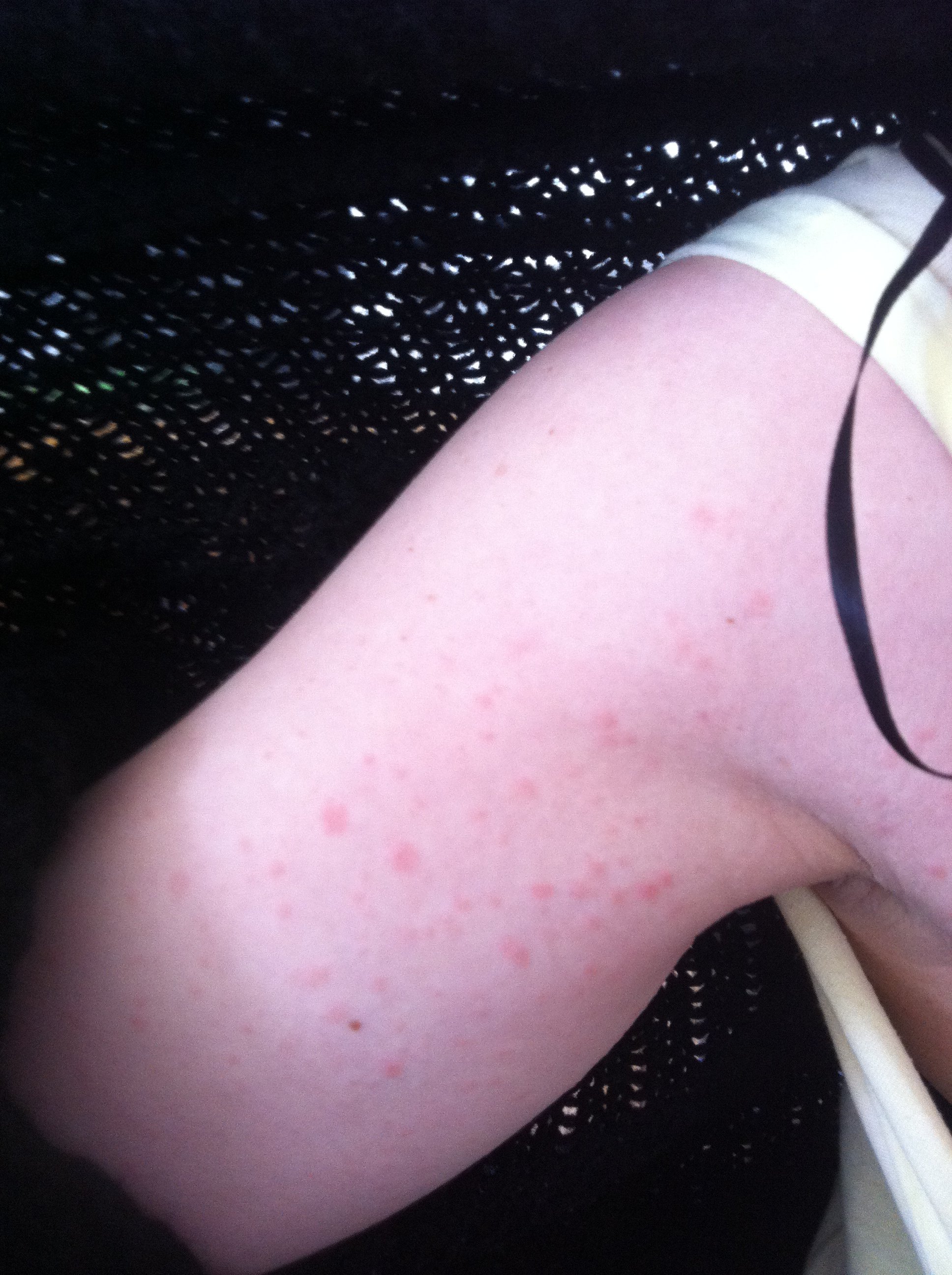 Plaques De Boutons Ventre Bras Acne Psoriasis Et Problemes De Peau Forum Sante Doctissimo