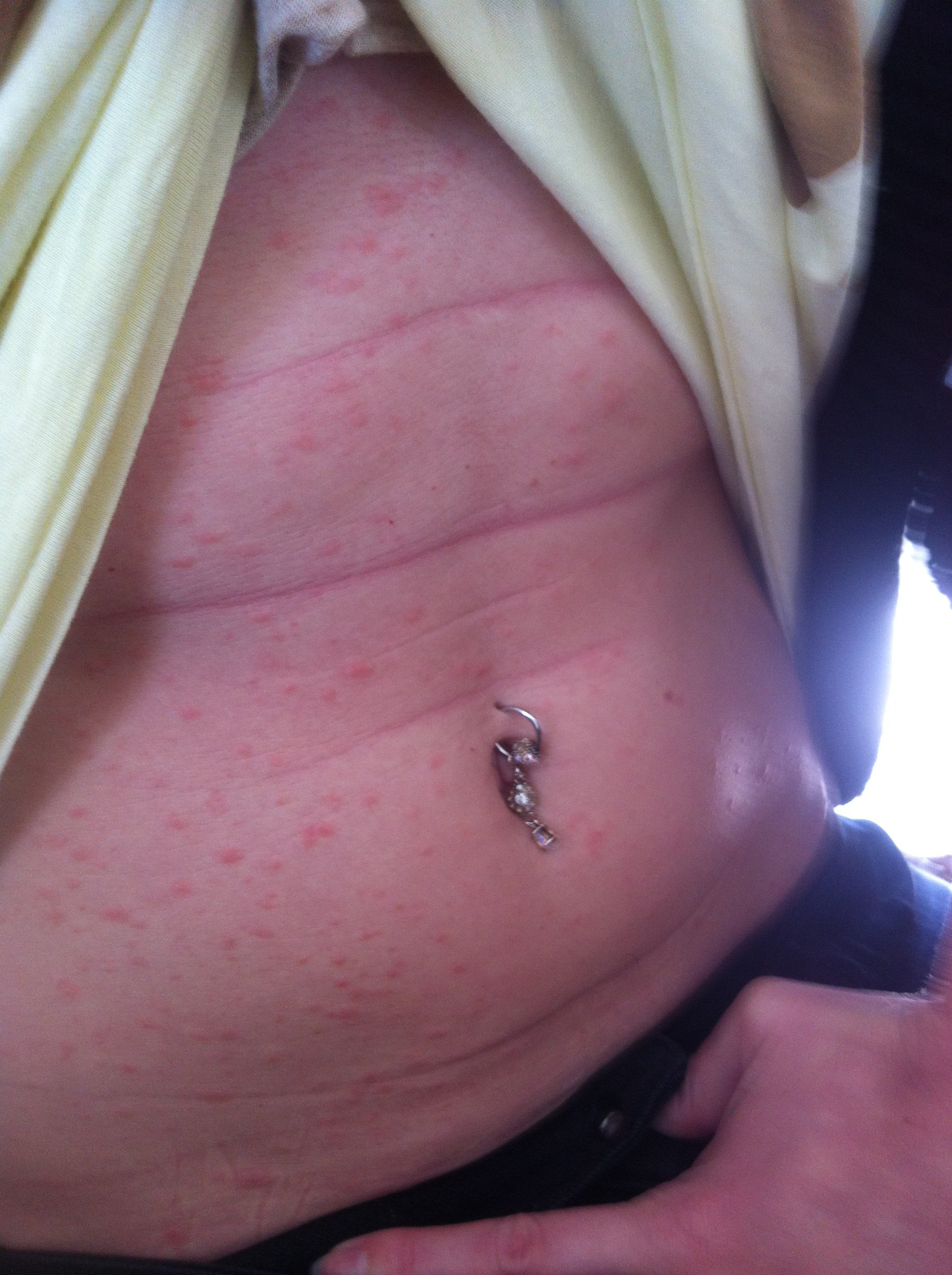 Plaques De Boutons Ventre Bras Acne Psoriasis Et Problemes De Peau Forum Sante Doctissimo