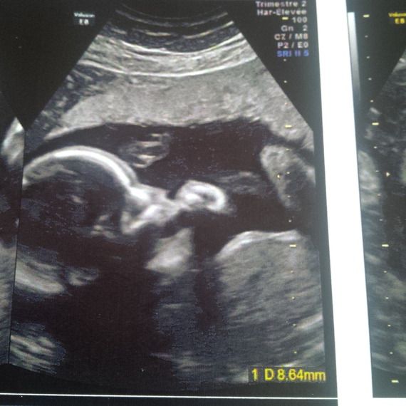 Bouche Ouverte Mais Non Il Ne Suce Pas Son Pouce Grossesse Laurecl Photos Club Doctissimo