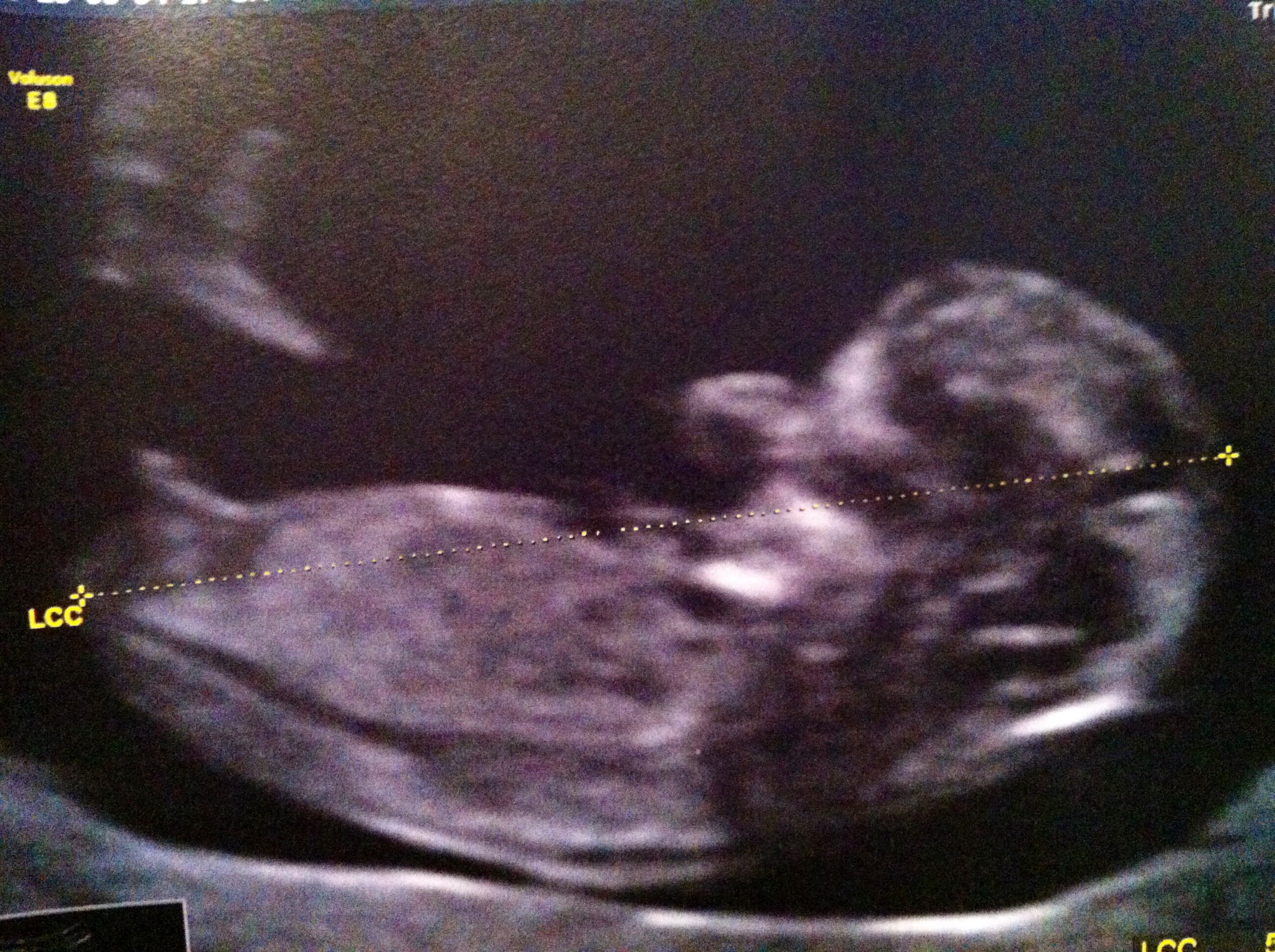 Echo 12sa De Ma Petite Grenouille Fille Ou Garcon Vos Avis Echographie Connaitre Le Sexe De Votre Bebe Forum Grossesse Amp Bebe Doctissimo Echo 12sa De Ma Petite Grenouille Fille Ou Garcon Vos Avis Echographie Connaitre Le Sexe De Votre Bebe Forum Grossesse Amp Bebe Doctissimo